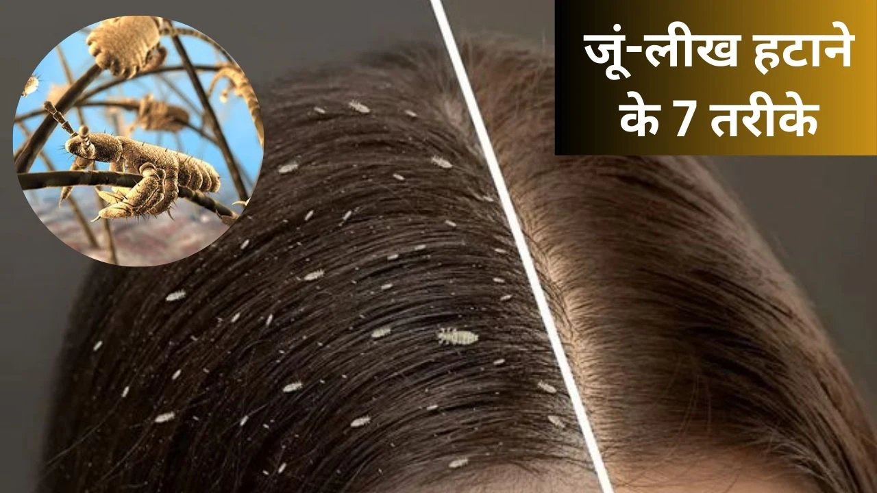पसीने की चिपचिपाहट से हो गए हैं जुएं और लीख, बालों से हटाने के लिए अपनाएं ये 7 तरीके