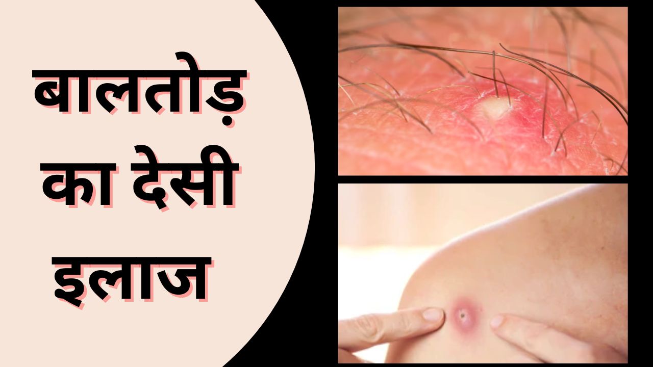 बालतोड़ हो जाए तो क्या करना चाहिए? इन घरेलू उपायों से मिलेगी राहत