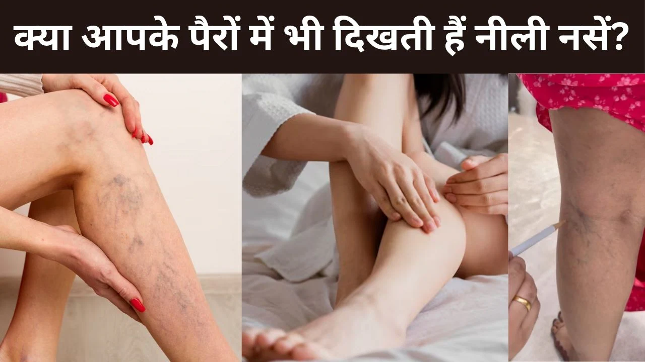 पैरों में नीली-नीली मकड़ी के जाले जैसे निशान दिखते हैं? Varicose Veins से छुटकारा पाने के लिए करें ये एक्सरसाइज