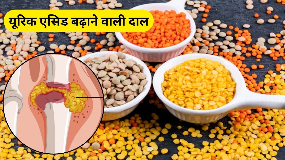 हाई यूरिक एसिड वाले इन 5 दालों से बना लें दूरी, नहीं तो उठना बैठना तक हो जाएगा मुश्किल, जानिए क्यों