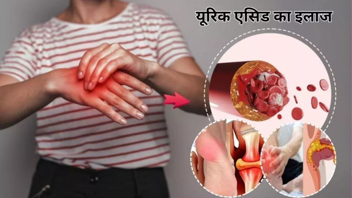यूरिक एसिड के 1-1 कंड को बाहर निकाल देंगी ये 4 चीजें, एक्सपर्ट से जानिए फायदे और कैसे करें इस्तेमाल