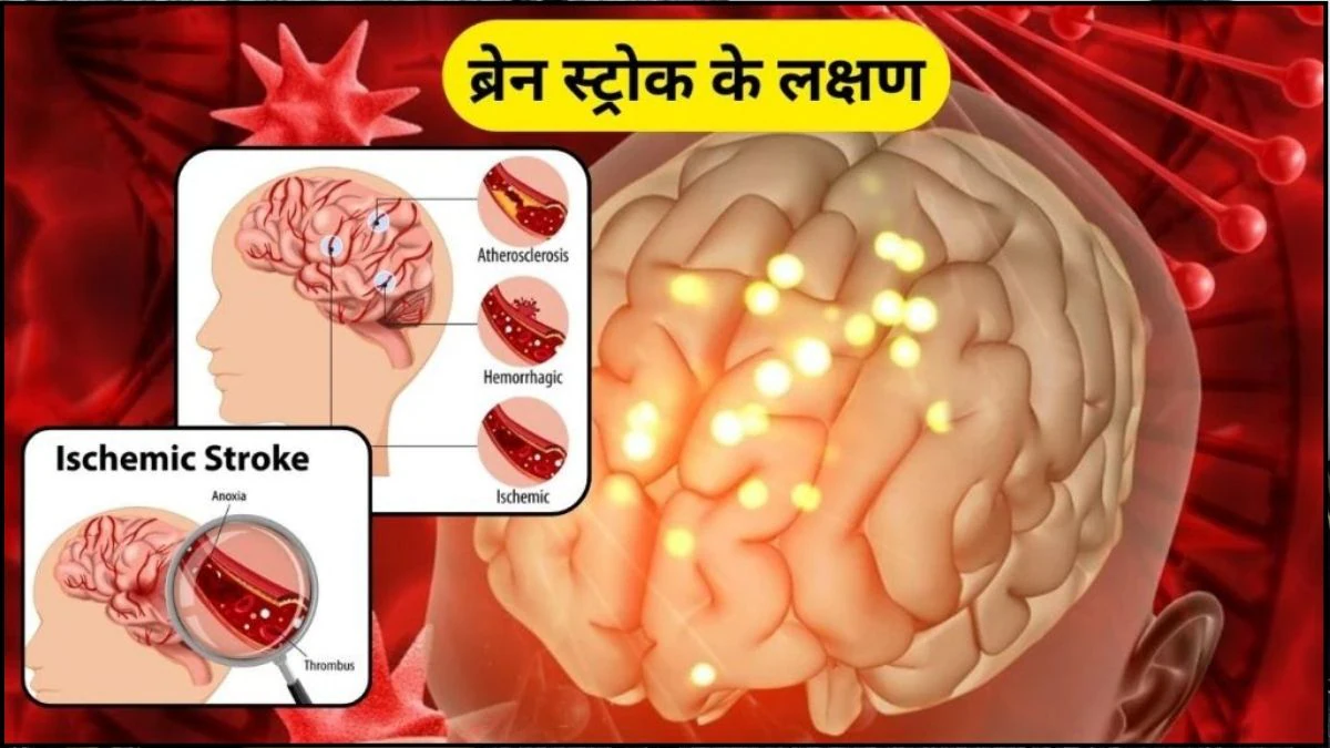 साइलेंट किलर है Stroke जो बिना वॉर्निंग कर देता है हमला, लेकिन BE FAST फॉर्मूला से जल्दी होगी इसकी पहचान, नजरअंदाज करना हो सकता है जानलेवा