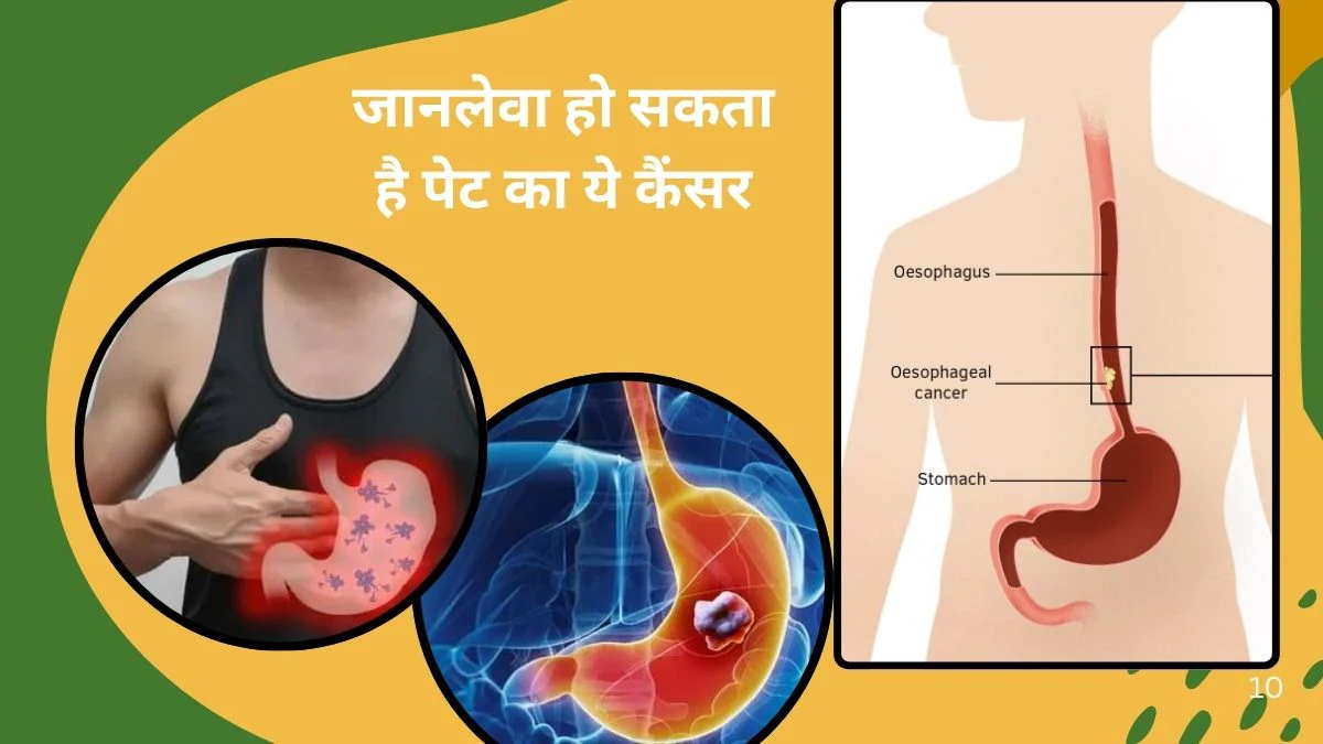 पेट में हमेशा लगता है बम का गोला भरा है, हो सकती है कैंसर की शुरुआत, 1 बैक्टीरिया बन जाता है पेट का दुश्मन, तुरंत करें बीमारी की पहचान